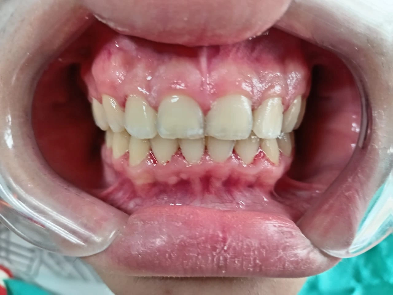 Después del tratamiento de Miguel